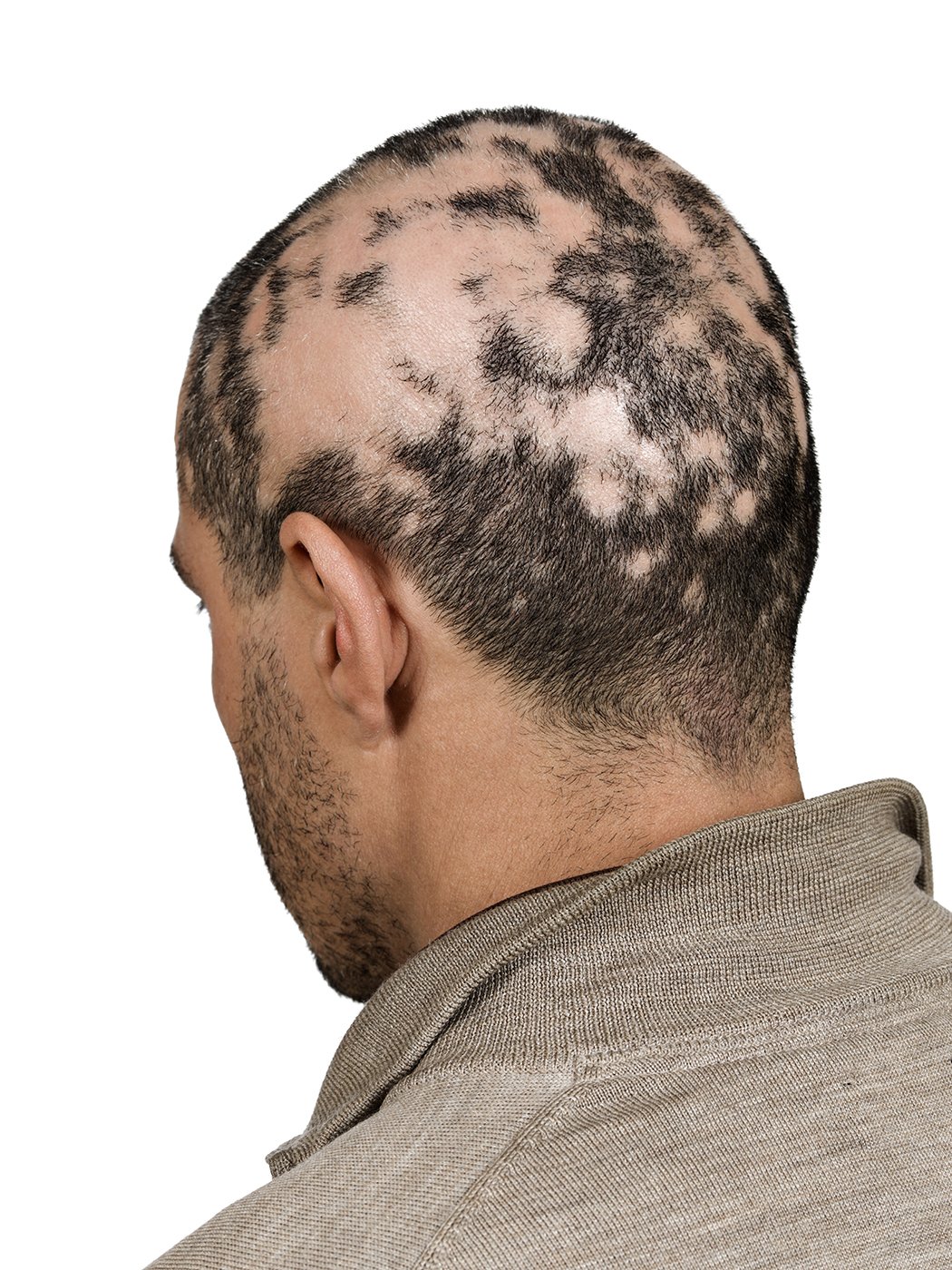 alopecia 3